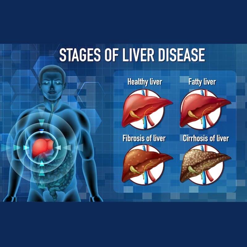 stages of liver diseases filaantro